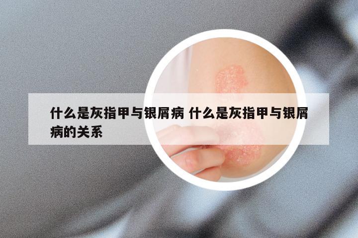 什么是灰指甲与银屑病 什么是灰指甲与银屑病的关系