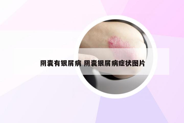 阴囊有银屑病 阴囊银屑病症状图片