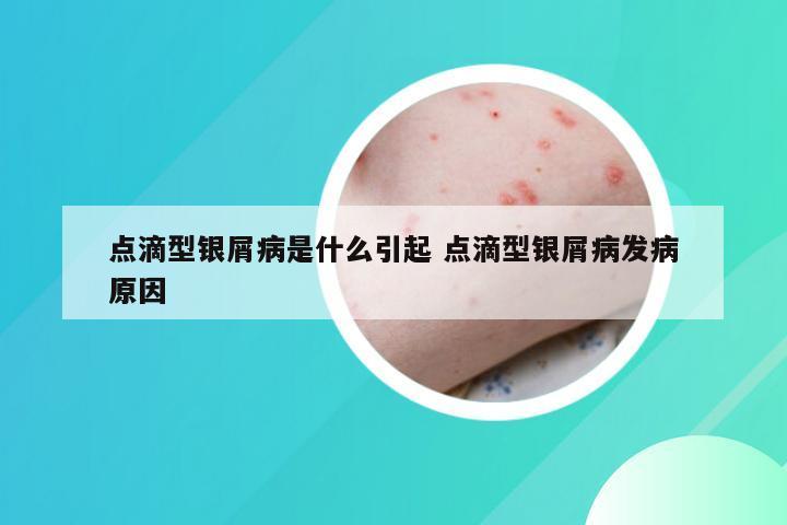 点滴型银屑病是什么引起 点滴型银屑病发病原因