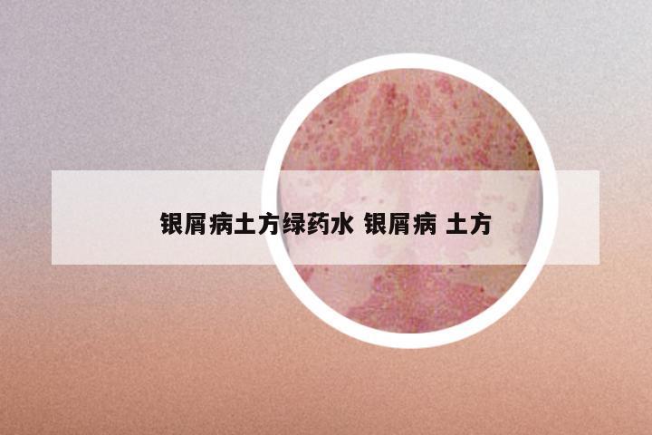银屑病土方绿药水 银屑病 土方