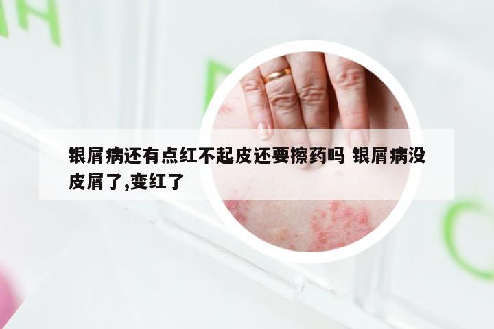 银屑病还有点红不起皮还要擦药吗 银屑病没皮屑了,变红了