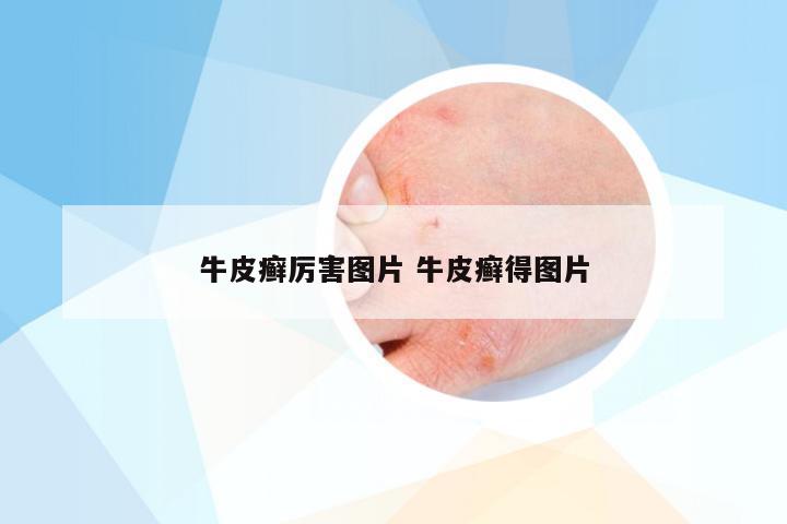 牛皮癣厉害图片 牛皮癣得图片