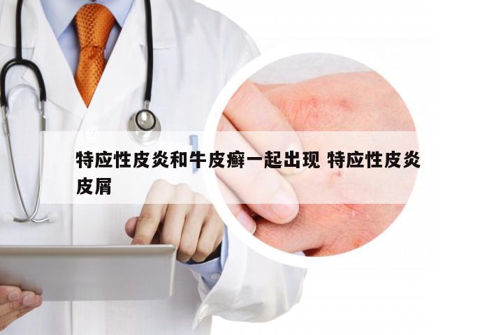 特应性皮炎和牛皮癣一起出现 特应性皮炎 皮屑