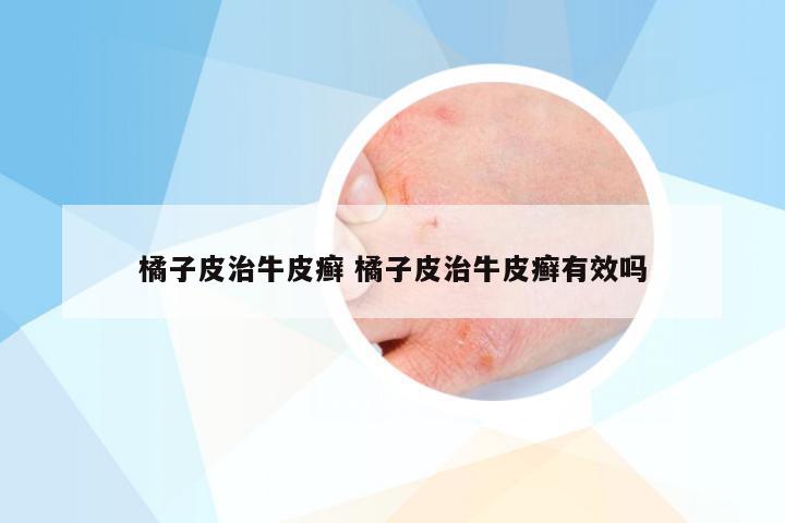 橘子皮治牛皮癣 橘子皮治牛皮癣有效吗