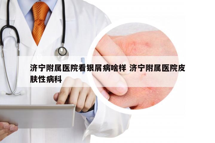 济宁附属医院看银屑病啥样 济宁附属医院皮肤性病科