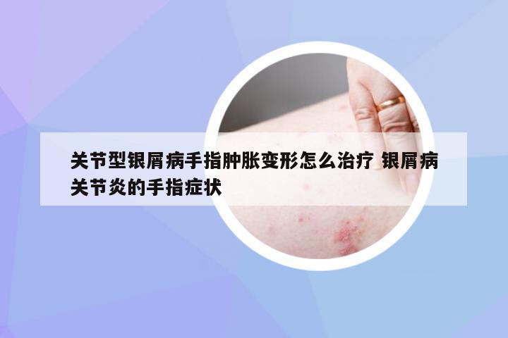 关节型银屑病手指肿胀变形怎么治疗 银屑病关节炎的手指症状