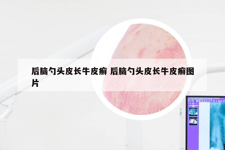 后脑勺头皮长牛皮癣 后脑勺头皮长牛皮癣图片