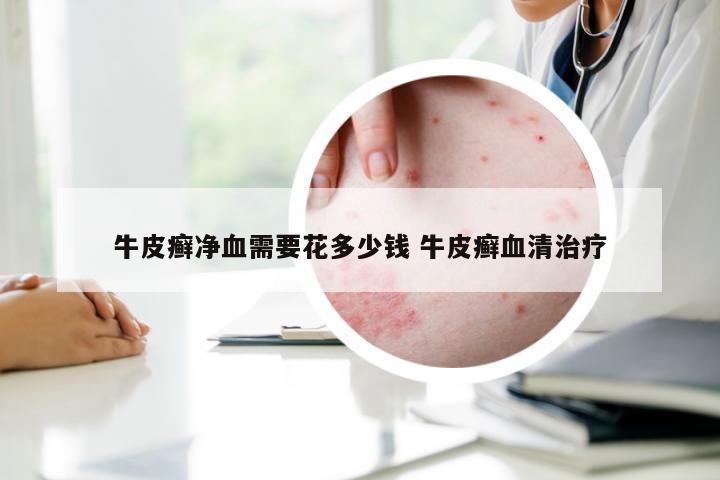 牛皮癣净血需要花多少钱 牛皮癣血清治疗