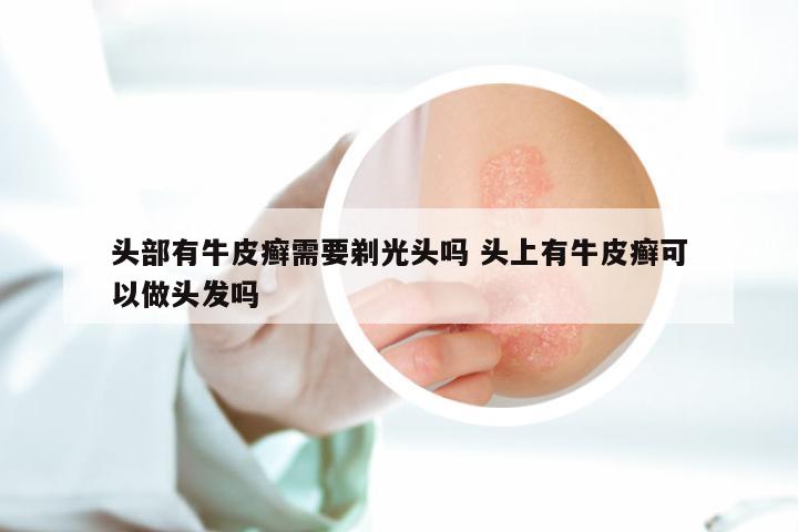 头部有牛皮癣需要剃光头吗 头上有牛皮癣可以做头发吗