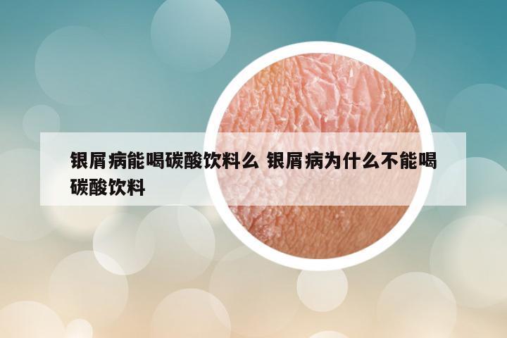 银屑病能喝碳酸饮料么 银屑病为什么不能喝碳酸饮料