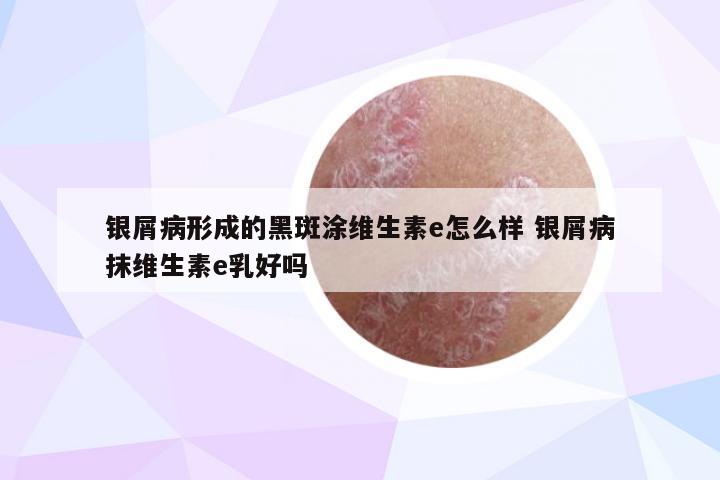 银屑病形成的黑斑涂维生素e怎么样 银屑病抹维生素e乳好吗