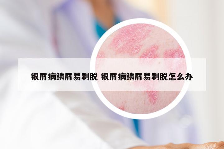 银屑病鳞屑易剥脱 银屑病鳞屑易剥脱怎么办