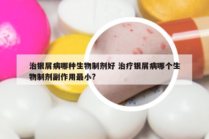 治银屑病哪种生物制剂好 治疗银屑病哪个生物制剂副作用最小?