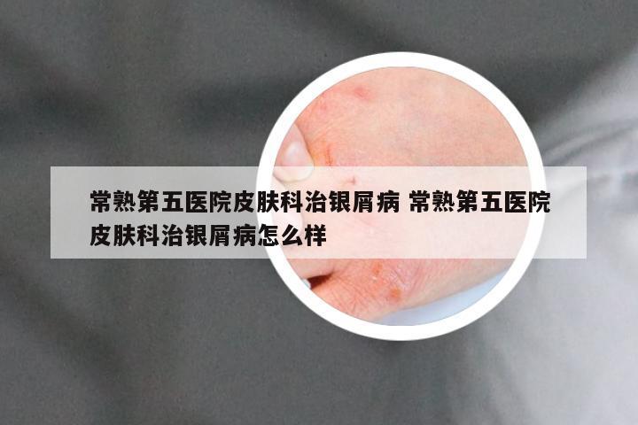 常熟第五医院皮肤科治银屑病 常熟第五医院皮肤科治银屑病怎么样