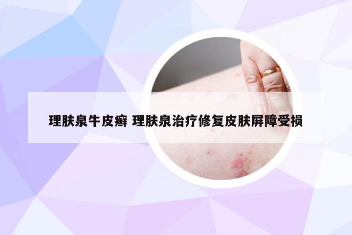 理肤泉牛皮癣 理肤泉治疗修复皮肤屏障受损