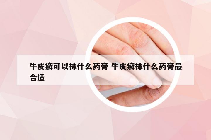 牛皮癣可以抹什么药膏 牛皮癣抹什么药膏最合适