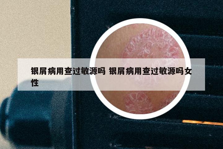 银屑病用查过敏源吗 银屑病用查过敏源吗女性