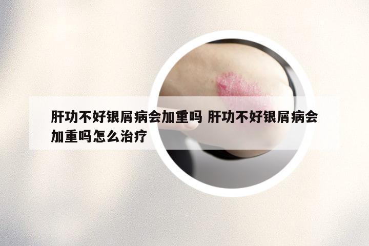 肝功不好银屑病会加重吗 肝功不好银屑病会加重吗怎么治疗
