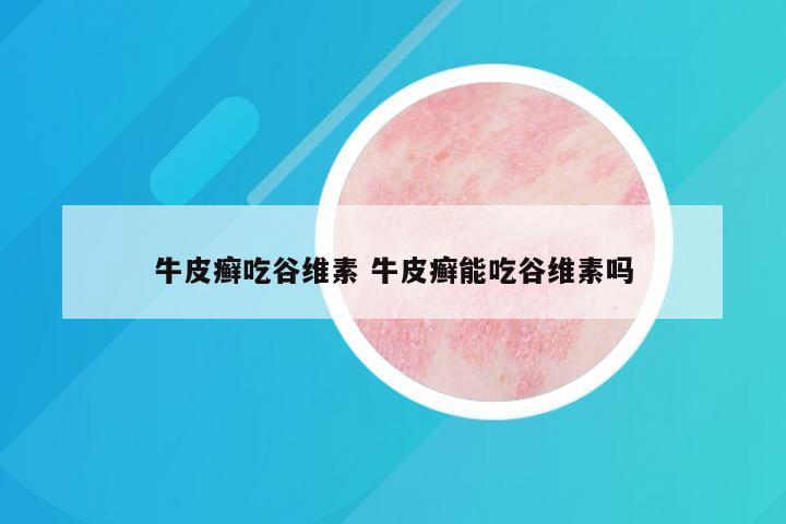 牛皮癣吃谷维素 牛皮癣能吃谷维素吗