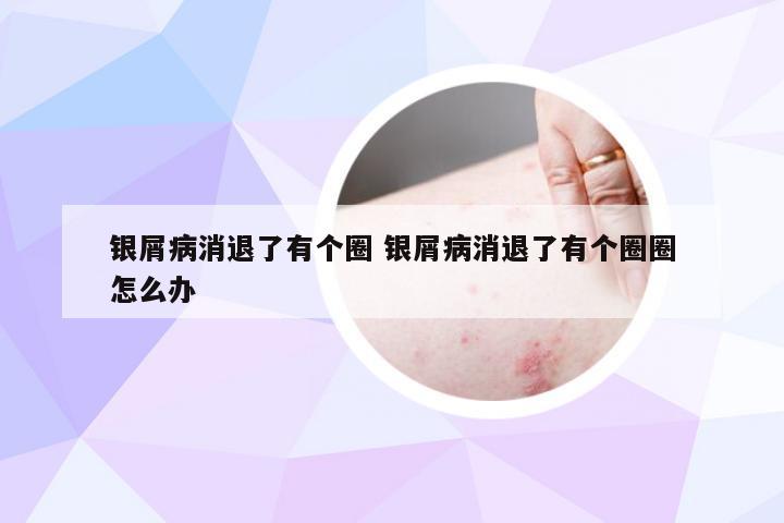 银屑病消退了有个圈 银屑病消退了有个圈圈怎么办