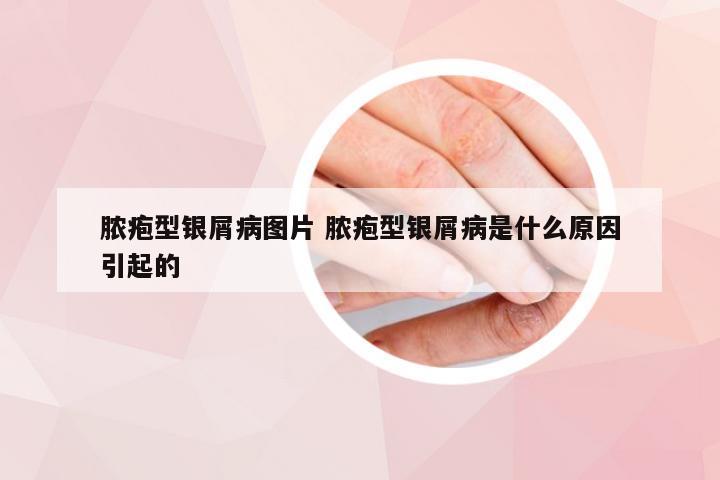 脓疱型银屑病图片 脓疱型银屑病是什么原因引起的