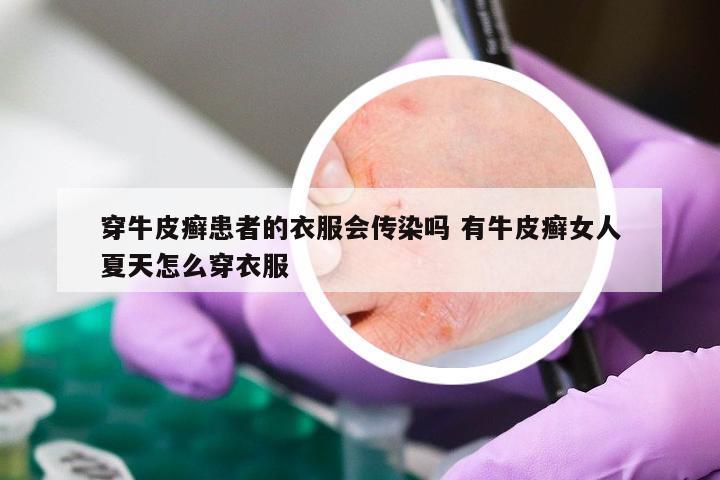 穿牛皮癣患者的衣服会传染吗 有牛皮癣女人夏天怎么穿衣服
