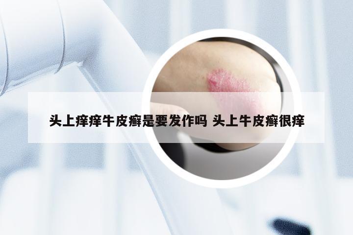 头上痒痒牛皮癣是要发作吗 头上牛皮癣很痒