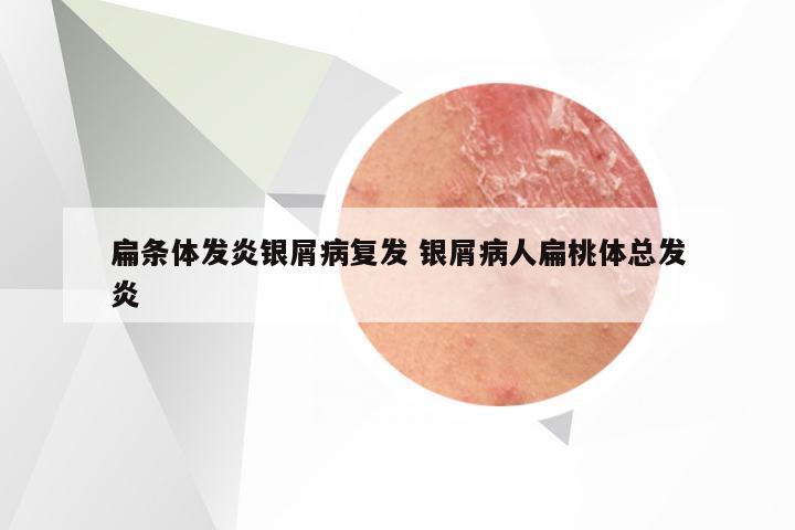 扁条体发炎银屑病复发 银屑病人扁桃体总发炎