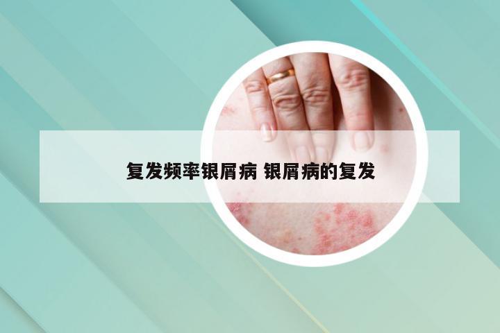 复发频率银屑病 银屑病的复发