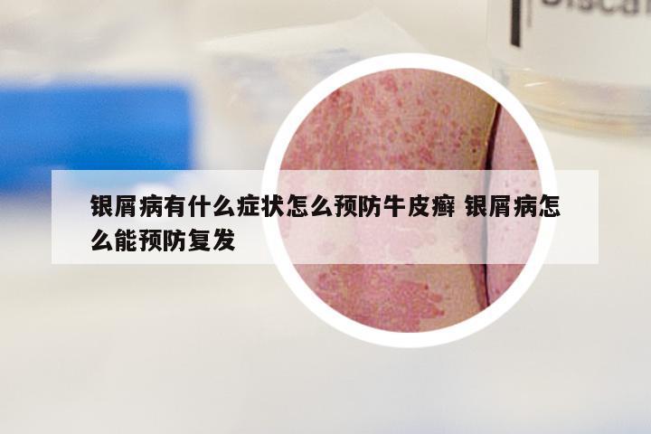 银屑病有什么症状怎么预防牛皮癣 银屑病怎么能预防复发