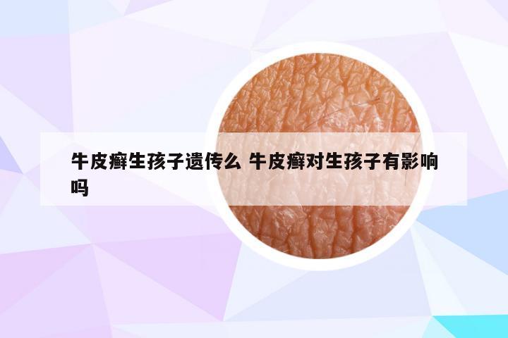 牛皮癣生孩子遗传么 牛皮癣对生孩子有影响吗