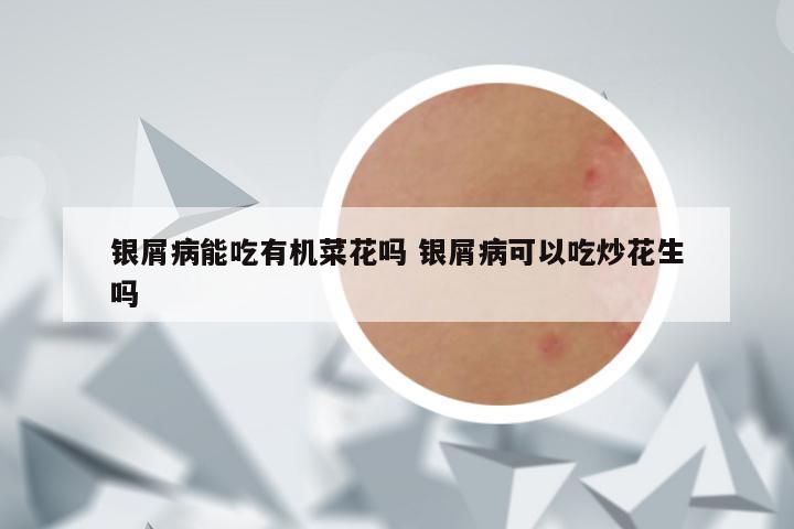 银屑病能吃有机菜花吗 银屑病可以吃炒花生吗