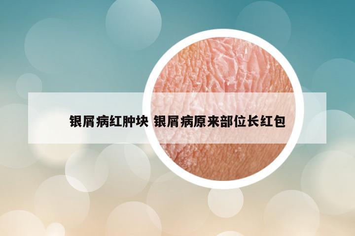 银屑病红肿块 银屑病原来部位长红包