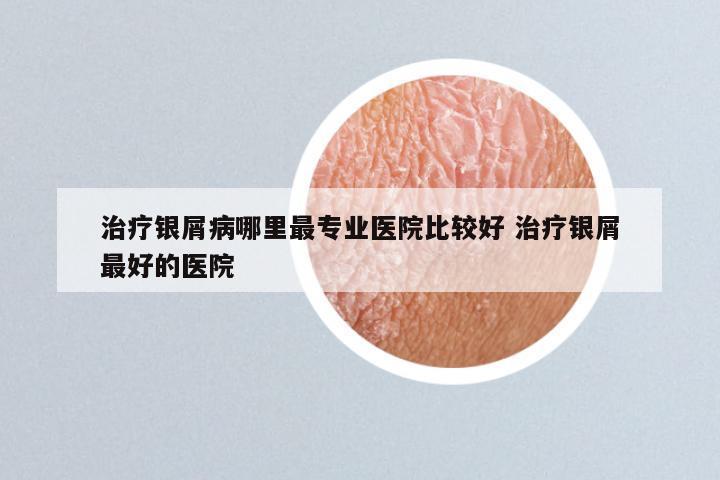 治疗银屑病哪里最专业医院比较好 治疗银屑最好的医院