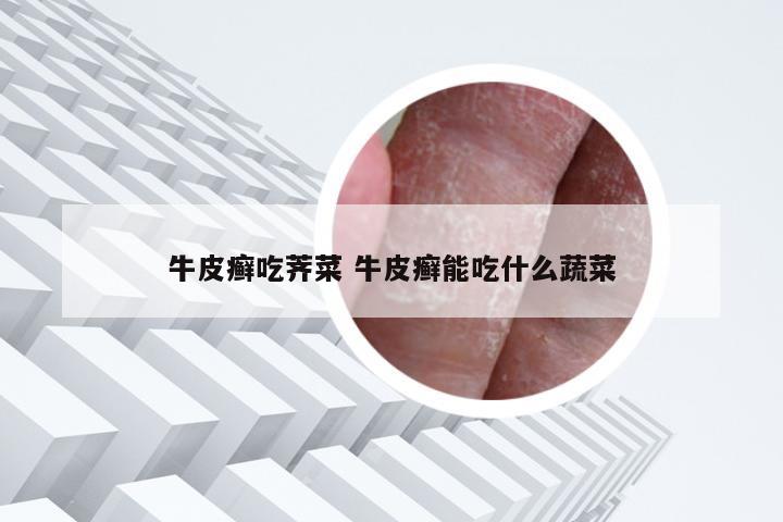 牛皮癣吃荠菜 牛皮癣能吃什么蔬菜