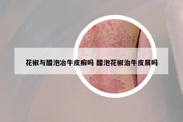 花椒与醋泡冶牛皮癣吗 醋泡花椒治牛皮屑吗