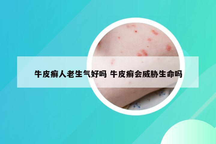 牛皮癣人老生气好吗 牛皮癣会威胁生命吗
