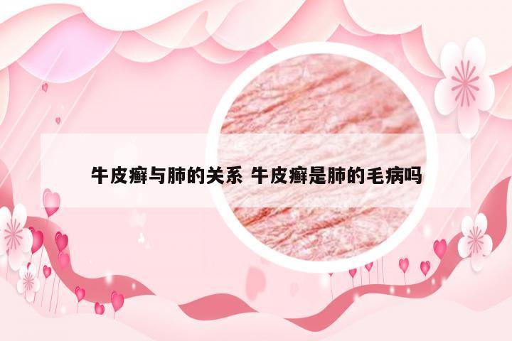 牛皮癣与肺的关系 牛皮癣是肺的毛病吗