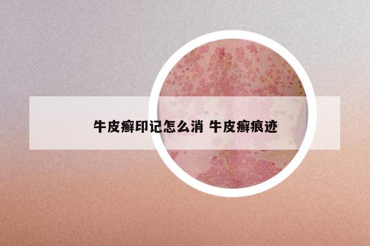 牛皮癣印记怎么消 牛皮癣痕迹