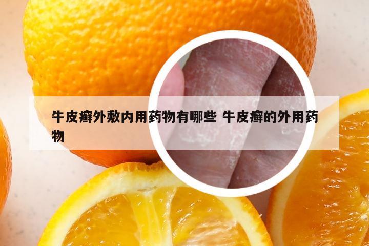 牛皮癣外敷内用药物有哪些 牛皮癣的外用药物