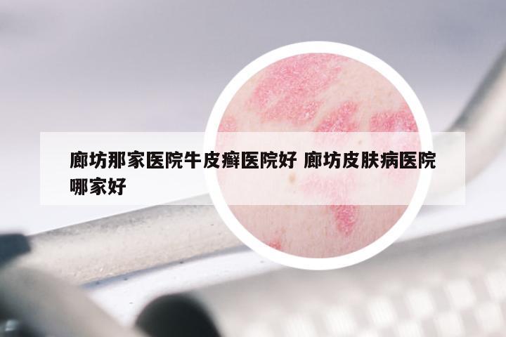 廊坊那家医院牛皮癣医院好 廊坊皮肤病医院哪家好