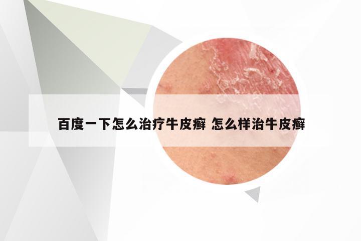 百度一下怎么治疗牛皮癣 怎么样治牛皮癣