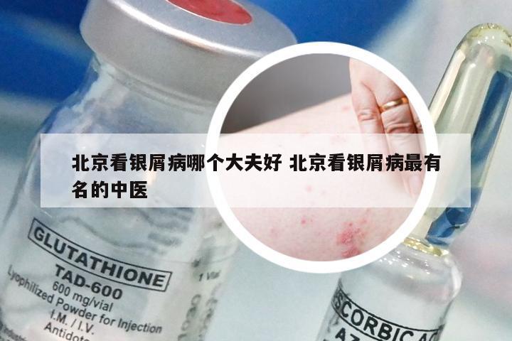 北京看银屑病哪个大夫好 北京看银屑病最有名的中医