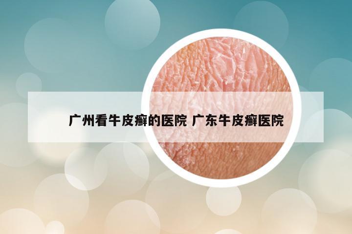 广州看牛皮癣的医院 广东牛皮癣医院