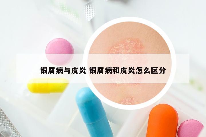 银屑病与皮炎 银屑病和皮炎怎么区分