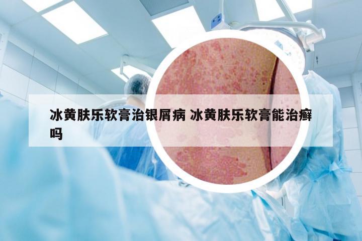 冰黄肤乐软膏治银屑病 冰黄肤乐软膏能治癣吗