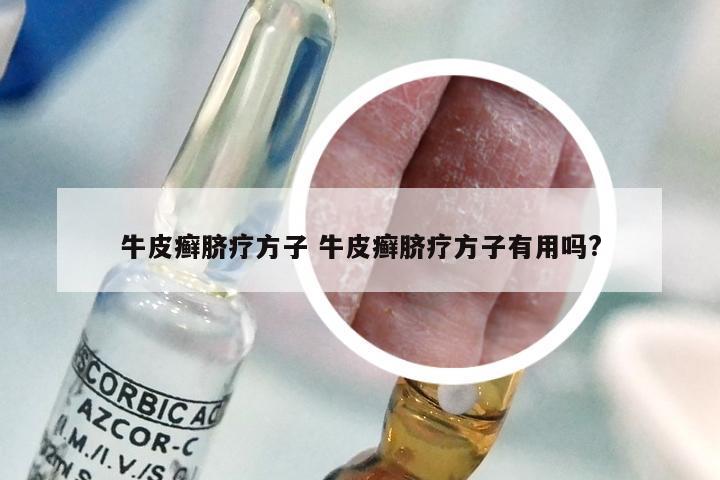 牛皮癣脐疗方子 牛皮癣脐疗方子有用吗?