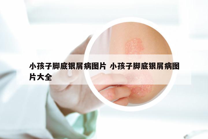 小孩子脚底银屑病图片 小孩子脚底银屑病图片大全