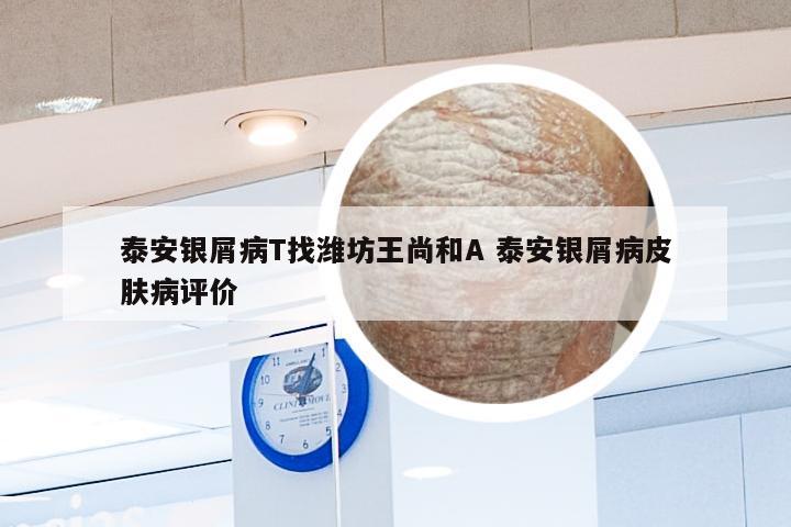 泰安银屑病T找潍坊王尚和A 泰安银屑病皮肤病评价