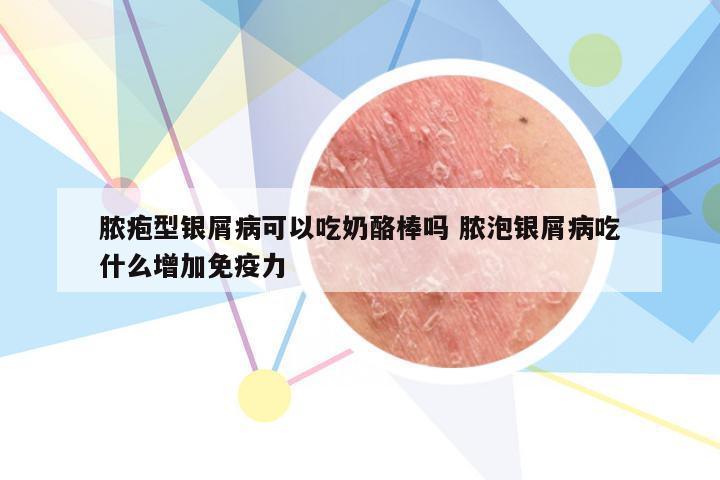 脓疱型银屑病可以吃奶酪棒吗 脓泡银屑病吃什么增加免疫力